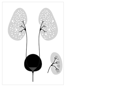 Illustration-Autosomal recessive polycystic kidney disease with a normal kidney inset
