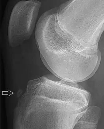 X-ray of a 15-year-old male, showing an older avulsion fracture of the tibial tuberosity.