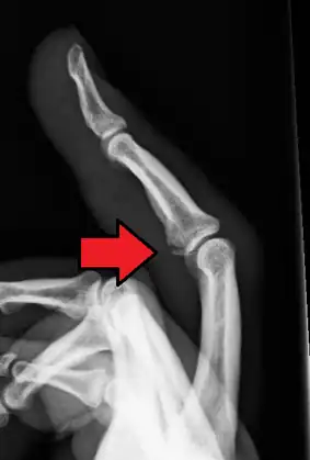 Avulsion fracture of the proximal middle phalanx on the palm side