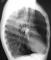 A lateral chest X-ray of a person with emphysema: Note the barrel chest and flat diaphragm.