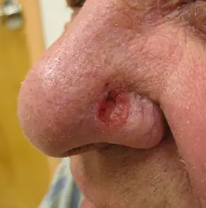 Solitary, pink, pearly appearing skin lesion on the side of an adult nose