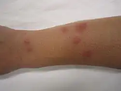 Bedbug bites