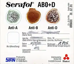 A blood typing card showing agglutination of red blood cells with anti-A and anti-D and a negative result with anti-B, indicating a type A positive blood type