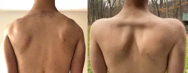 Scapula-to-scapula scapulopexy, pre- and post-operation. The scapulas are tethered together into a retracted position with an Achilles tendon graft, which, in this case, rendered the rhomboid major muscles distinguishable.