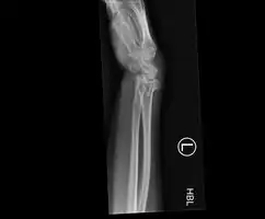Bilateral Colles fractures/lateral