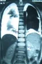 Bilateral chylothorax seen on a thoracic MRI