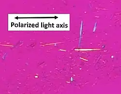 Uric acid crystals in polarized light, showing negative birefringence, with yellow color when aligned parallel to the axis of the red compensator, and blue when perpendicular.