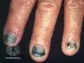 Black nails with pseudomonas infection