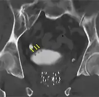 CT Urography shows multiple tumors