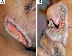 Nodular skin lesions of blastomycosis