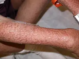 Multiple, reddish-brown papules coalescing over the right arm in a boy with Blau syndrome
