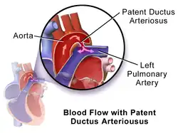 Illustration of Patent Ductus Arteriosus