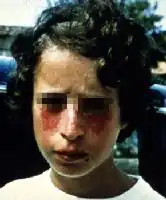 An individual with Bloom syndrome