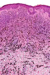 Micrograph of a blue nevus showing the characteristic pigmented melanocytes between bundles of collagen. H&E stain.