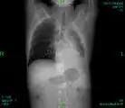 CT scan chest: Bone cancer in back and ribs, spread from lung cancer.