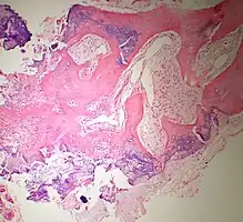 Bone Bizzare Parosteal Osteochondromatous Proliferation