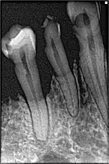 Dental radiograph showing bone loss in a 32 year old heavy smoker