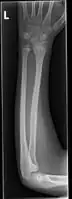 Front view of bowing fractured radius and ulna
