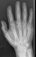 Boxer fracture