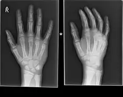 Boxer fracture of the 4th and 5th knuckles