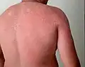Skin peeling following sunburn