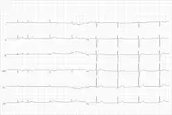Electrocardiogram from a man with tachycardia-bradycardia syndrome following mitral valvuloplasty, resection of the left atrial appendage, and maze procedure. The ECG shows AV-junctional rhythm resulting in bradycardia at around 46 beats per minute.