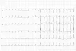 This ECG from the same patient shows atrial fibrillation at around 126 beats per minute.