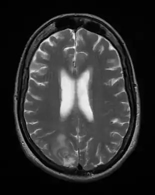 Cerebral toxoplasmosis (with primary involvement in the right occipital lobe)