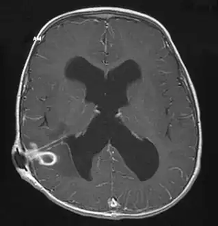 MRI (T1 with contrast) showing the ring-enhancing lesion. From a rare case report of an abscess formed as a complication of the CSF shunt. Jamjoom et al., 2009.