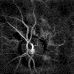 Branch retinal vein occlusion revealed by laser Doppler imaging through flow alteration in the upper right branch artery.