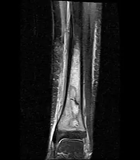 Coronal fat suppressed STIR image showing, bone marrow and subcutaneous edema as well as subperiosteal edema.  The thin hypointense rim surrounding the intramedullary collection represents the reactive interface between the abscess and the body's attempt to wall it off.