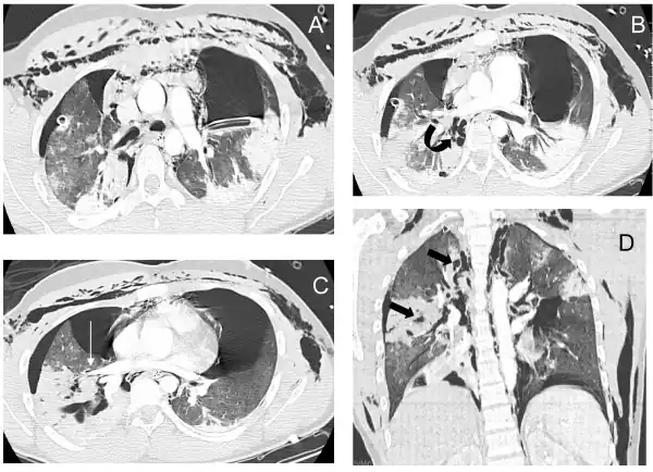 A patient with traumatic complete disruption of the right bronchus. Computed tomography scan following emergency chest tube drainage. Axial 1.25 mm thick sections with a lung window. (a) Persistent bilateral pneumothorax, pneumomediastinum and extensive subcutaneous emphysema. (b) Multiple lucencies around the right bronchial tree (curved arrow) precluding the correct recognition of the bronchial rupture. (c) The Macklin effect around the right lower pulmonary vein (white arrow). (d) Coronal view demonstrating multiple areas of alveolar consolidation in the right upper and lower lobes: intraparenchymal lucencies resulting from lung lacerations are visible on the right side (thick arrows).