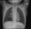 Chest radiograph demonstrates thickening and dilatation of the bronchioles