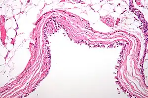 Histological micrographic image of a bronchogenic cyst of the mediastinum. Sample has been stained with hematoxylin and eosin to improve contrast.