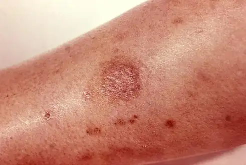 Scarring from a recluse bite after four months