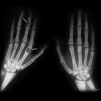 X-ray of the hands showing brown tumors in the long bones of the fingers