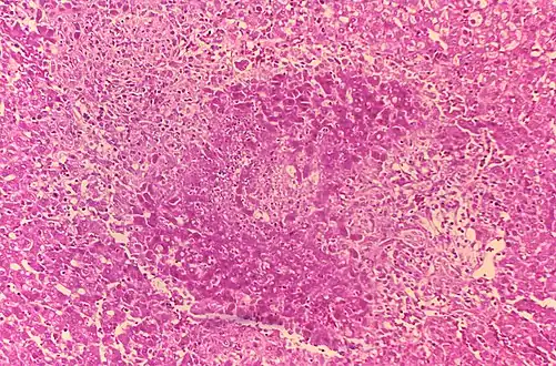 Granuloma and necrosis in the liver of a guinea pig infected with Brucella suis