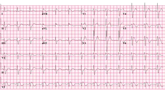 Type 1 Brugada ECG pattern (note non-standard lead position, V5 is placed one intercostal space above V1 and V6 is placed one intercostal space above V2)..