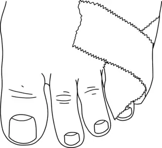 fourth and fifth toeswrapped in a loop of tape which crosses over the bases of the toes, with the ends overlapping onto the body of the foot.