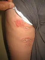 Bullous impetigo on the arm