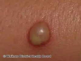 Bullous impetigo