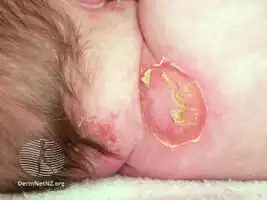 Bullous impetigo