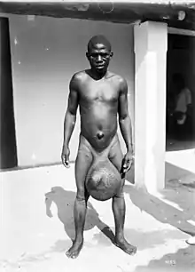 Man with massive scrotal elephantiasis, Tanzania, early 20th century
