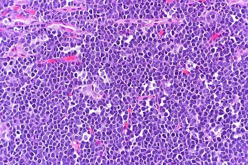 High-power view of Burkitt lymphoma with "starry sky" appearance. H&E stain.
