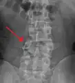 A burst fracture of L4 as seen on plane X ray