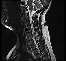 MRI scan of cervical disc herniation between C6 and C7 vertebrae