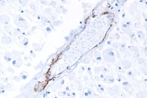 A micrograph showing punctate immunostaining (brown) with a Notch 3 antibody, as is characteristic in CADASIL.
