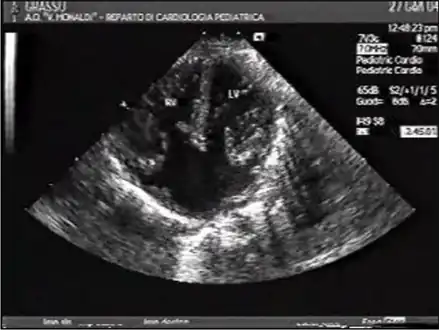 Ultrasound showing a complete atrioventricular septal defect