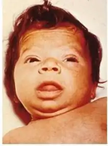 Close up of face, showing myxedematous facies, macroglossia, and skin mottling
