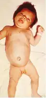 3-month-old infant with untreated CH; picture demonstrates hypotonic posture, myxedematous facies, macroglossia, and umbilical hernia